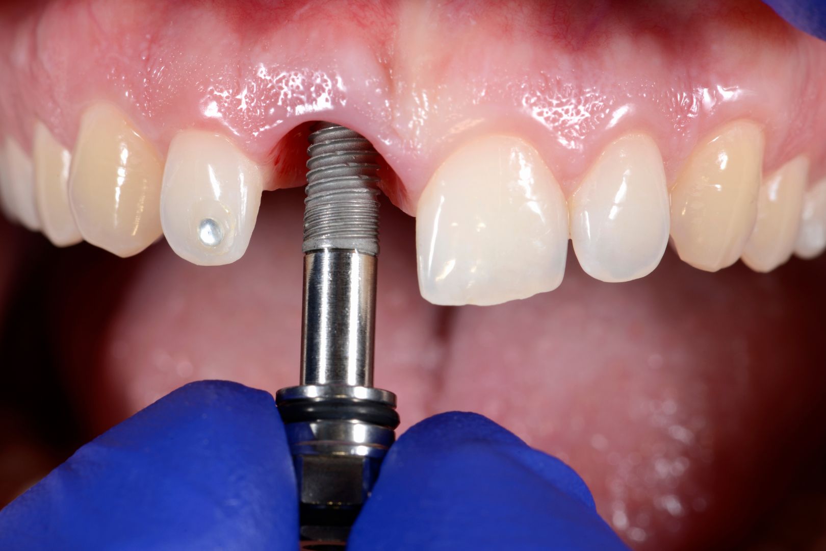 Como Funciona o Enxerto Osseo para Implante Dentario